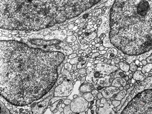 M,4y. | medulloblastoma M,4y. | medulloblastoma
